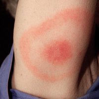 Аллергия на нервной почве