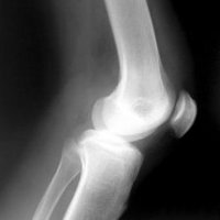 Разрыв связок коленного сустава: первая помощь
